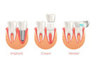 Visit Functional Aesthetic Dentistry in Las Vegas to enjoy Same Day Crowns at your convenience!