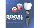 Experience Superior Dental Implant Solutions in Summerlin at Functional Aesthetic Dentistry