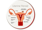 Understanding Fibroids and Blood Clots: Causes and Solutions