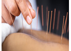 Best Treatment for Acupuncture in King's Cross