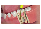 Affordable Root Canal Treatment cost in India