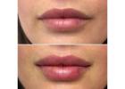 Best lip filler in Delhi