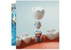 Get the Best Dental Implants in Columbia, SC by Soda City Dentistry