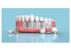 Affordable Dental Implants in India