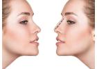 Best Clinics for Rhinoplasty in Dubai: Top Picks 2024