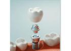 Soda City Dentistry: Your Trusted Provider for Dental Implants In Columbia, SC