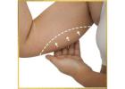 Achieve Sculpted Perfection with Liposuction Fat Transfer in Los Angeles