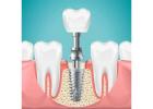 Dental Implants: Cost, Procedure & Benefits