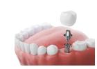 Dental Implants in Mount Roskill, Auckland