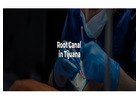 Bring back your true smile with our treatment of root canal in Tijuana