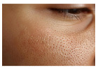 Open Pores Treatment in Delhi