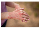 Atopic Dermatitis Treatment in Delhi for Long-Lasting Skin Relief