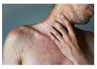 Urticaria Treatment in Delhi for Effective Relief from Hives and Allergic Skin Reactions