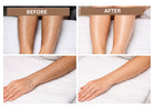 Laser Hair Removal in Delhi – Safe & Long-Lasting Hair Reduction