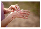 Eczema Treatment in Delhi – Expert Care for Healthy Skin