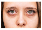 Under Eye Hollowness Treatment in Delhi: Restore Volume & Brighten Eyes