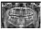 Find Trustworthy Teeth Replacements with Tijuana Dental Implants