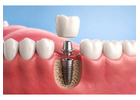 Dental Implants in Perth – Restore Your Smile with Iluka Dental Centre